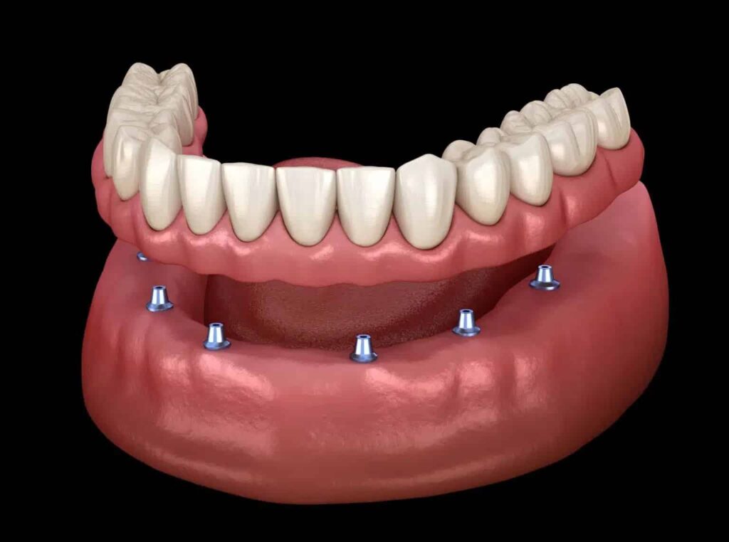 Implant Gigi Indramayu
